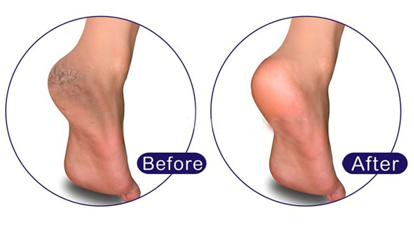 Chà gót chân là gì ?